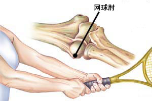 砭術(shù)冶療“網(wǎng)球肘”