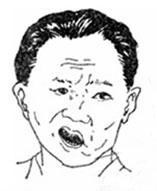 砭石療法驅(qū)風(fēng)活絡(luò)醫(yī)治面癱效果顯著
